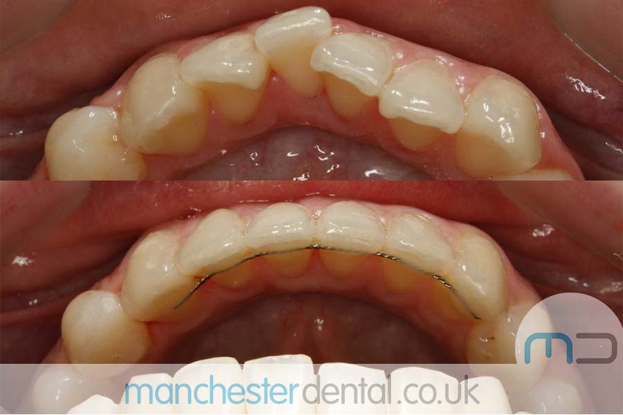 manchester dental orthodontics work gallery (8) manchester dental orthodontics work gallery (8)