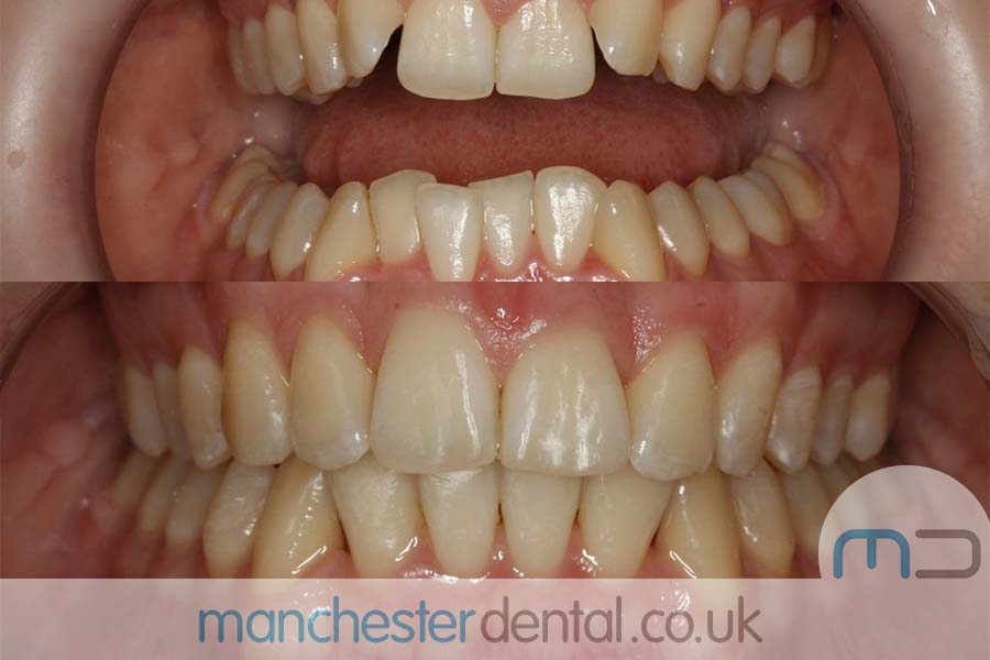 manchester dental orthodontics work gallery (9) manchester dental orthodontics work gallery (9)