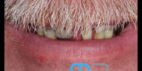 manchester-dental-same-day-implants-before1 manchester-dental-same-day-implants-before1