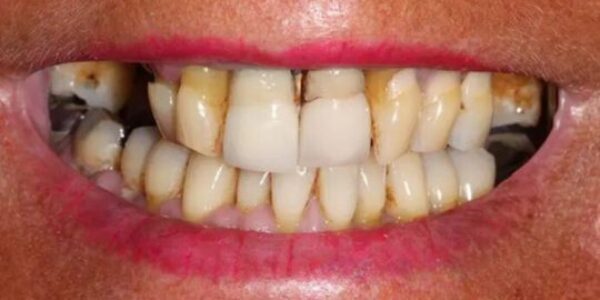 manchester-dental-same-day-implants-before2 manchester-dental-same-day-implants-before2