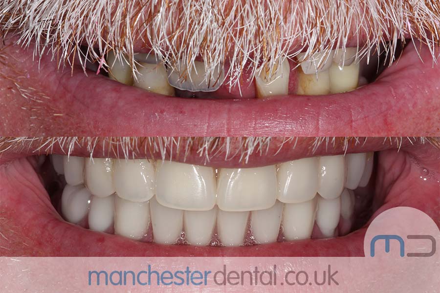 manchester-dental-same-day-implants-gallery (1) manchester-dental-same-day-implants-gallery (1)