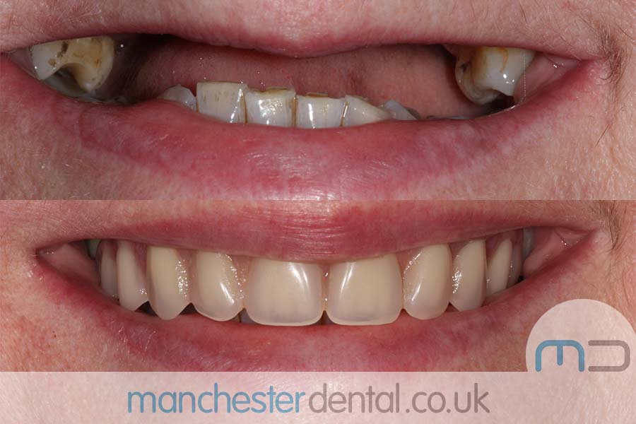 manchester-dental-same-day-implants-gallery (10) manchester-dental-same-day-implants-gallery (10)
