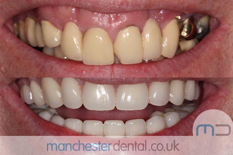 manchester-dental-same-day-implants-gallery (11) manchester-dental-same-day-implants-gallery (11)