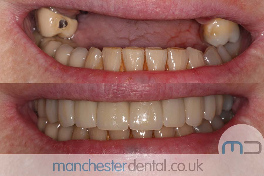 manchester-dental-same-day-implants-gallery (12) manchester-dental-same-day-implants-gallery (12)