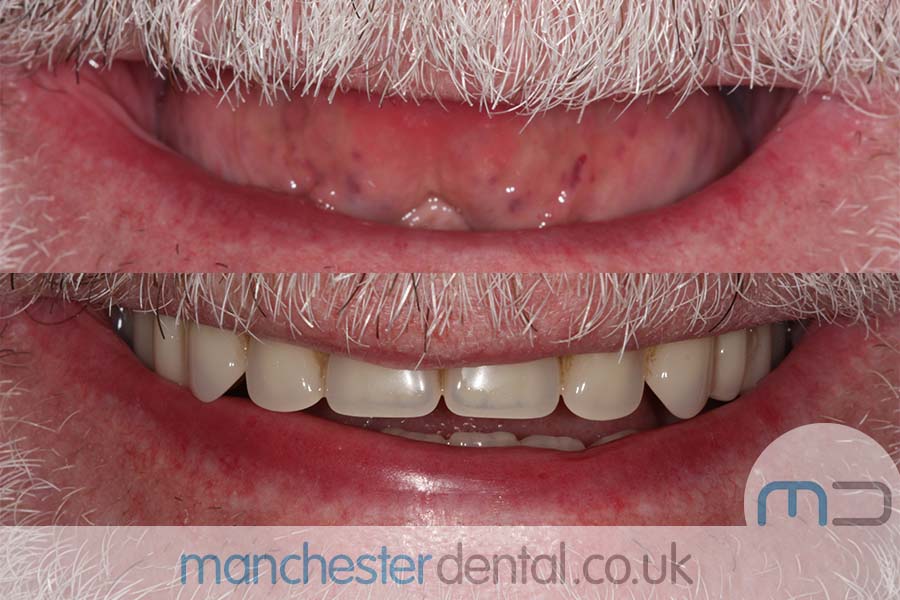 manchester-dental-same-day-implants-gallery (2) manchester-dental-same-day-implants-gallery (2)