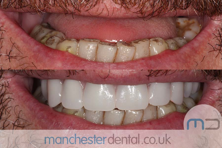 manchester-dental-same-day-implants-gallery (3) manchester-dental-same-day-implants-gallery (3)