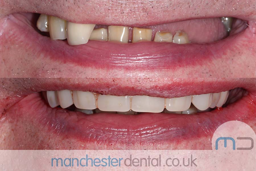 manchester-dental-same-day-implants-gallery (4) manchester-dental-same-day-implants-gallery (4)