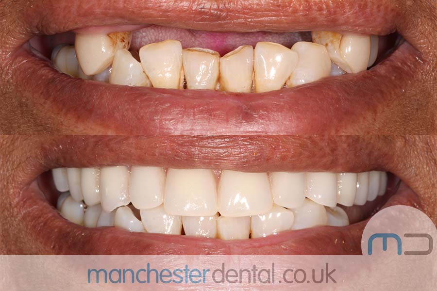 manchester-dental-same-day-implants-gallery (5) manchester-dental-same-day-implants-gallery (5)
