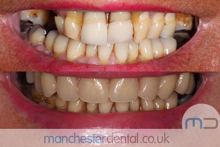 manchester-dental-same-day-implants-gallery (7) manchester-dental-same-day-implants-gallery (7)