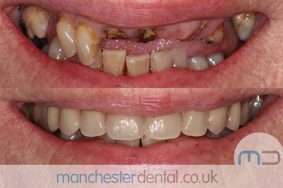 manchester-dental-same-day-implants-gallery (8) manchester-dental-same-day-implants-gallery (8)