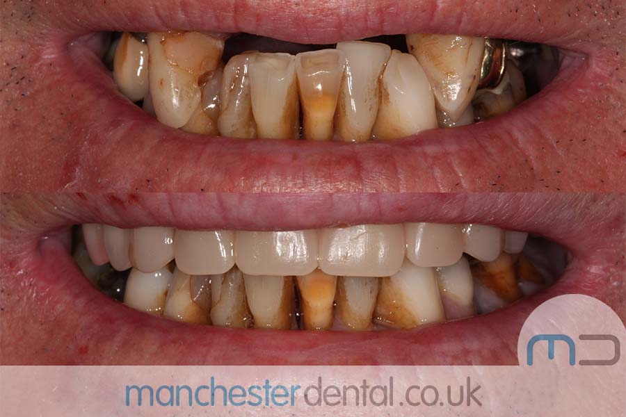 manchester-dental-same-day-implants-gallery (9) manchester-dental-same-day-implants-gallery (9)