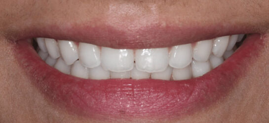 manchester-dental-teeth-whitening--before-after-3