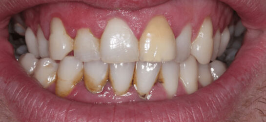 manchester-dental-teeth-whitening--before-after-4