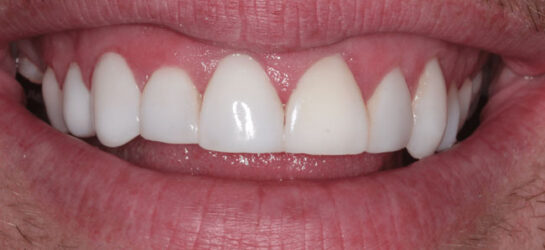 manchester-dental-teeth-whitening--before-after-5