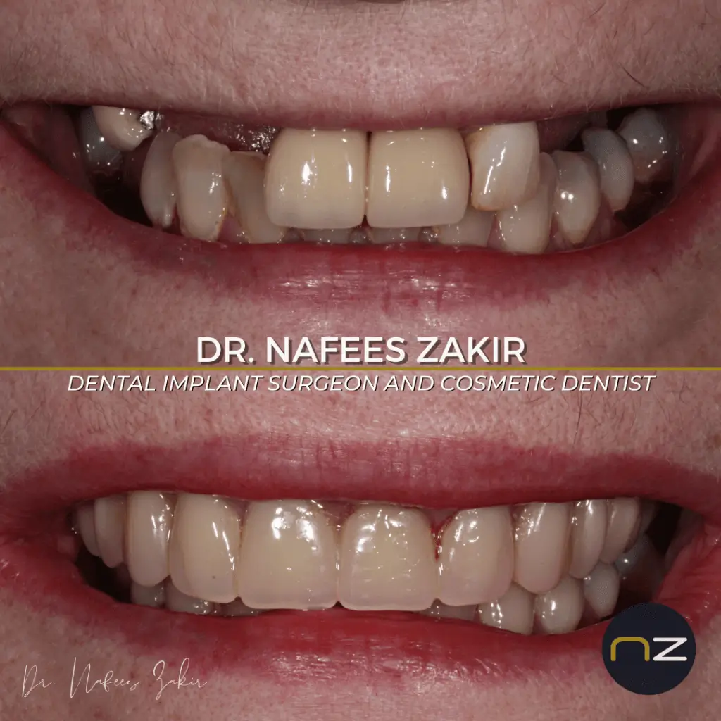 Before and After Dental Treatment Before and after images of a dental treatment showing improved teeth alignment and appearance.