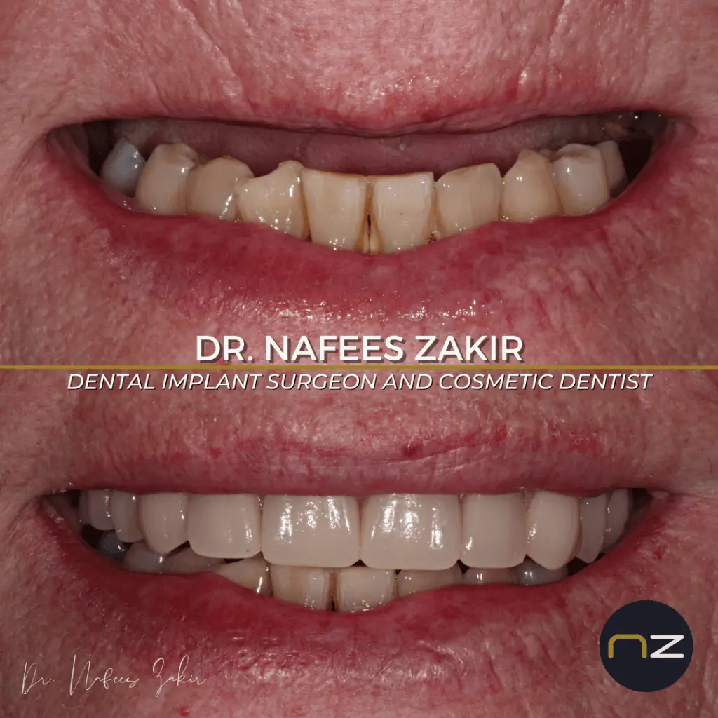 Dental Patient Before and After Treatment Before and after images of a dental patient's smile showing significant improvement in teeth alignment and color.