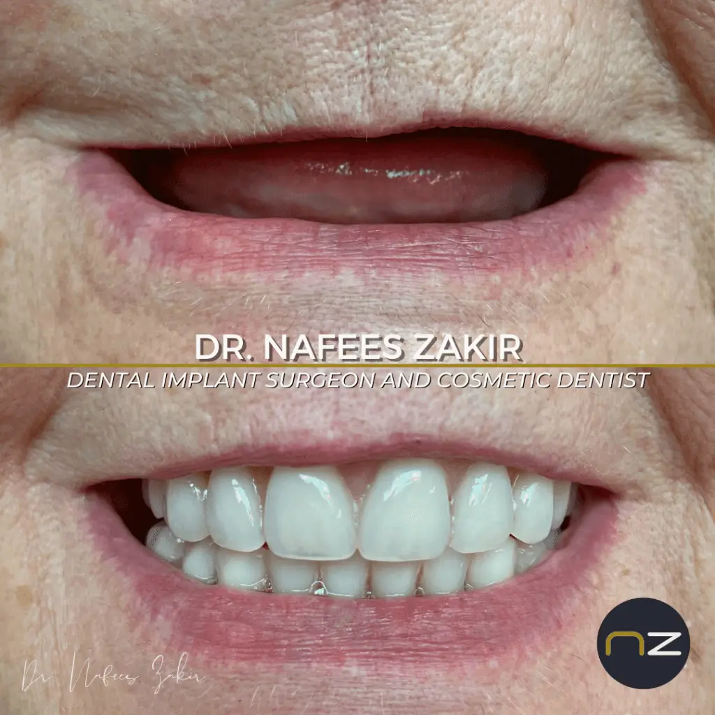 Close-up of a Smiling Patient's Mouth Close-up view of a smiling patient's mouth showing healthy teeth and gums.