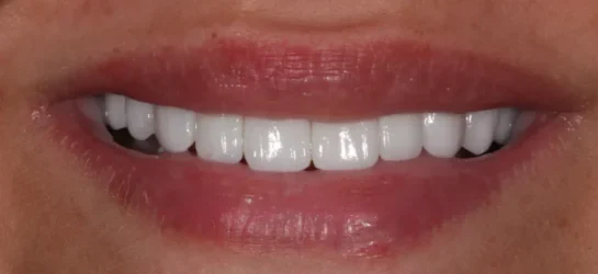smile makeover-manchester dental after1