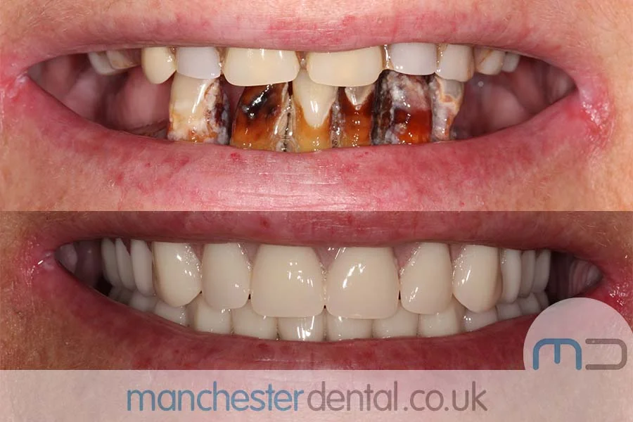 smile makeover-manchester dental gallery (1) smile makeover-manchester dental gallery (1)