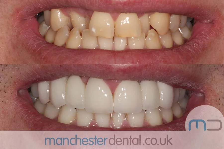 smile makeover-manchester dental gallery (10) smile makeover-manchester dental gallery (10)