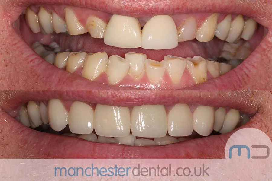 smile makeover-manchester dental gallery (12) smile makeover-manchester dental gallery (12)