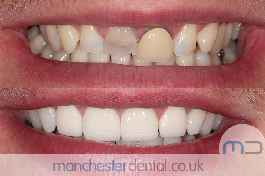 smile makeover-manchester dental gallery (3) smile makeover-manchester dental gallery (3)
