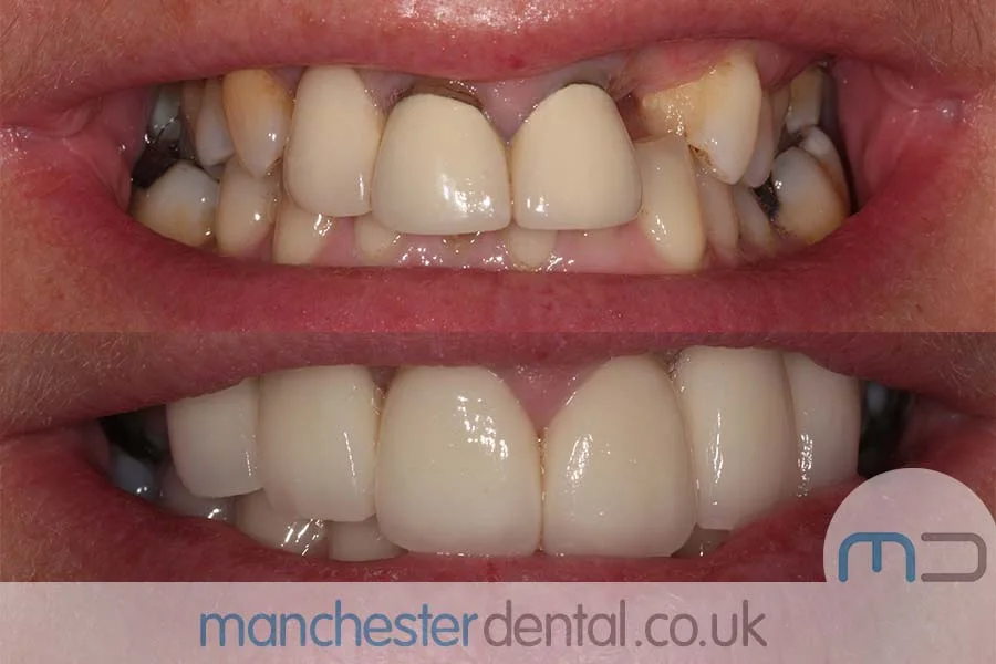 smile makeover-manchester dental gallery (4) smile makeover-manchester dental gallery (4)