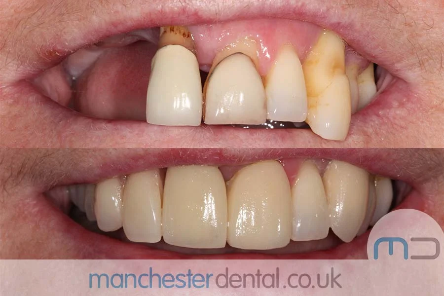 smile makeover-manchester dental gallery (5) smile makeover-manchester dental gallery (5)