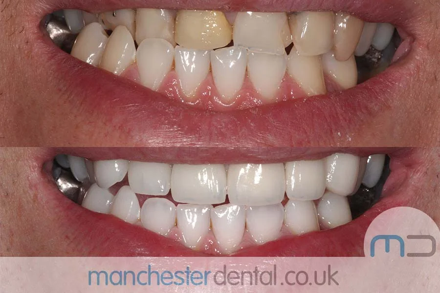smile makeover-manchester dental gallery (6) smile makeover-manchester dental gallery (6)