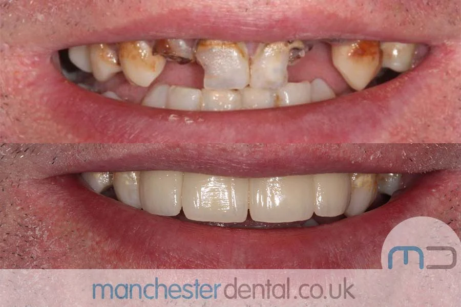 smile makeover-manchester dental gallery (7) smile makeover-manchester dental gallery (7)