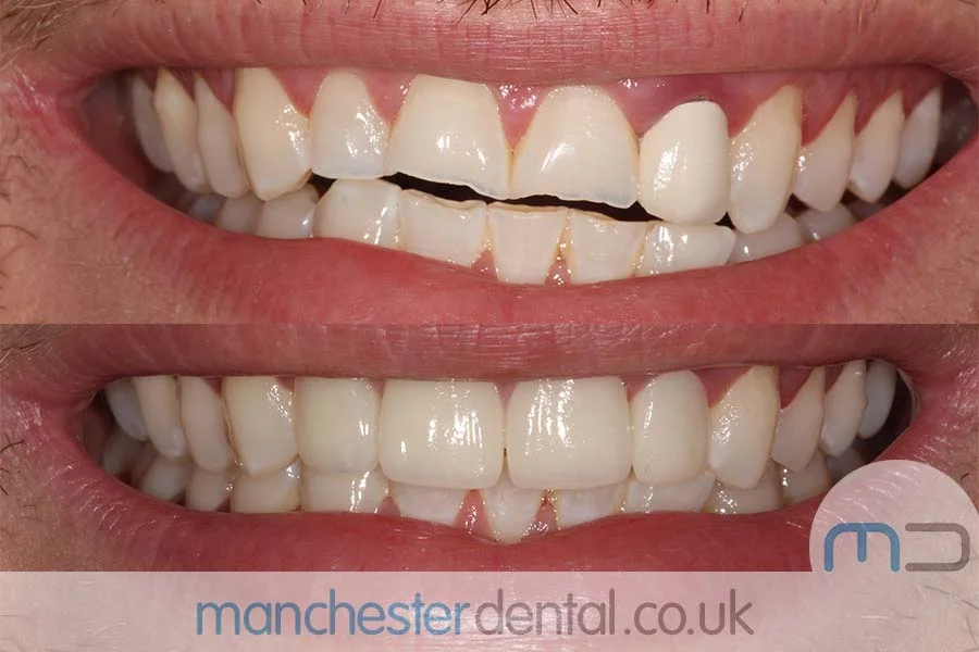 smile makeover-manchester dental gallery (8) smile makeover-manchester dental gallery (8)