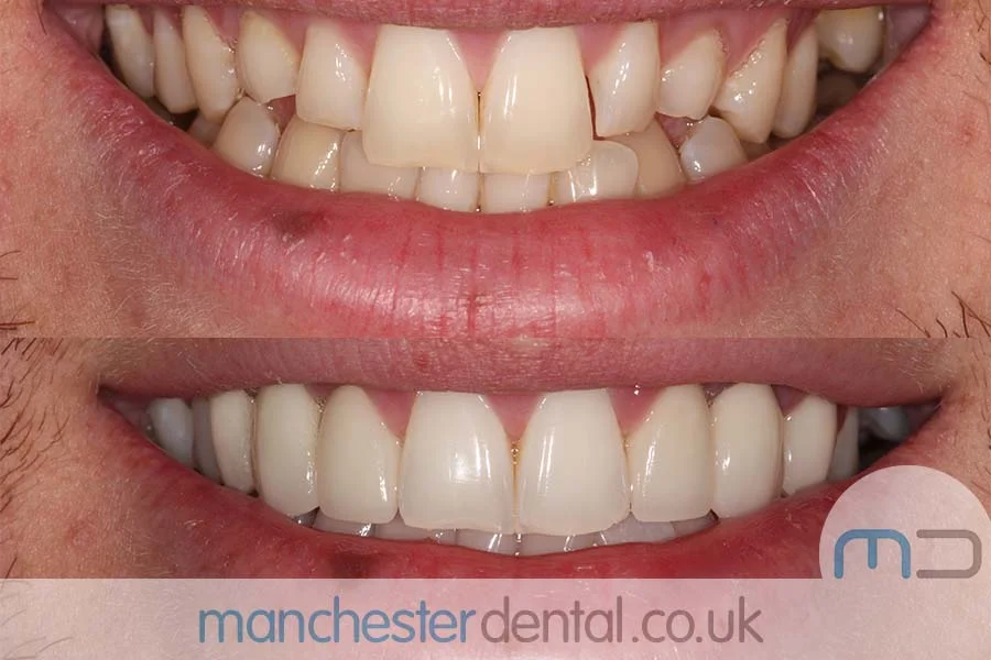 smile makeover-manchester dental gallery (9) smile makeover-manchester dental gallery (9)