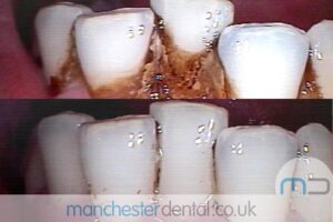 strain removal-manchester dental gallery (1) strain removal-manchester dental gallery (1)