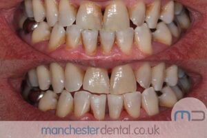 strain removal-manchester dental gallery (2) strain removal-manchester dental gallery (2)