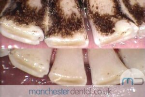 strain removal-manchester dental gallery (5) strain removal-manchester dental gallery (5)