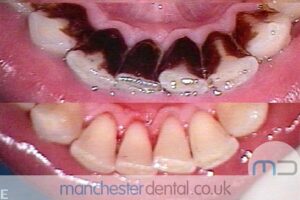 strain removal-manchester dental gallery (7) strain removal-manchester dental gallery (7)