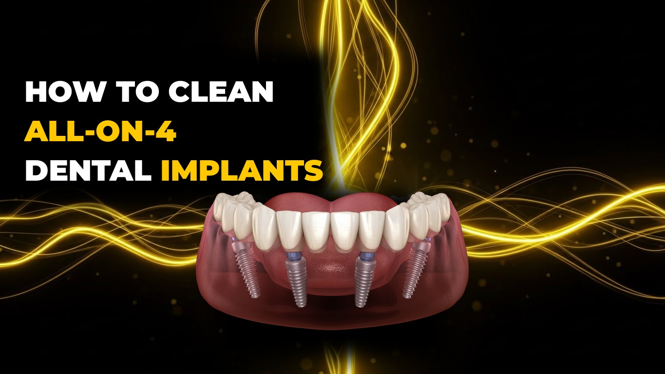 How To Clean All-On-4 Dental Implants