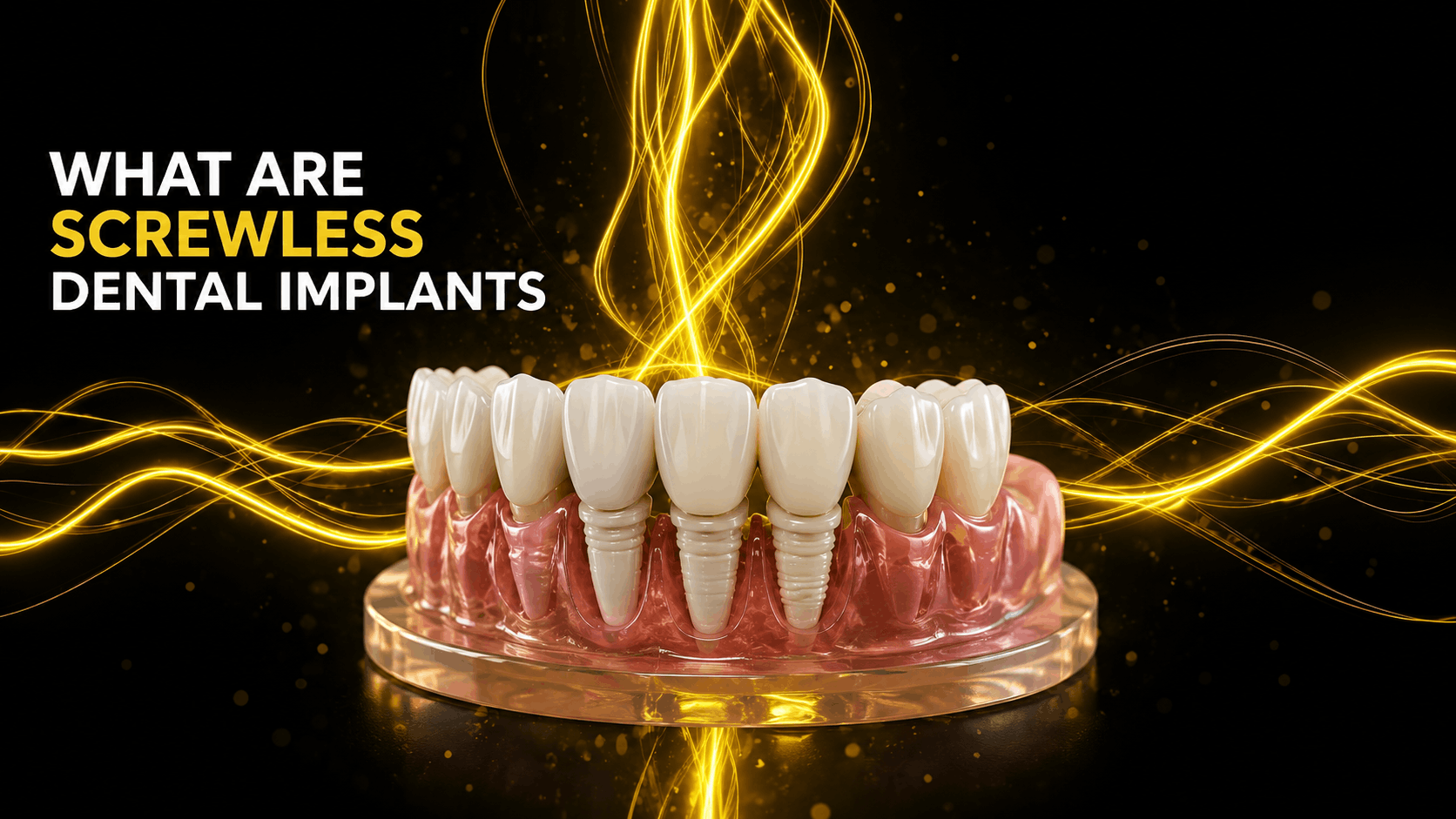 What Are Screwless Dental Implants What Are Screwless Dental Implants