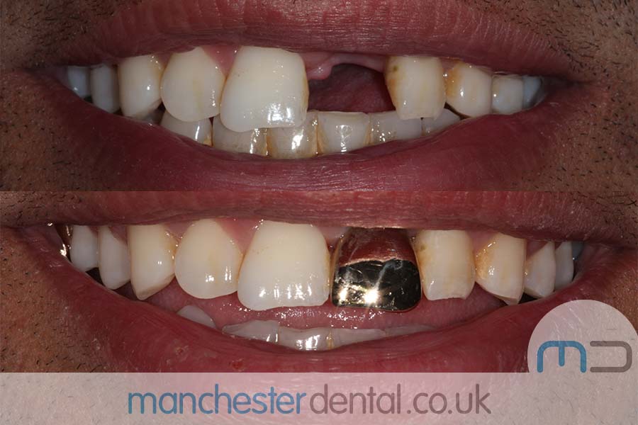 Permanent shop gold teeth