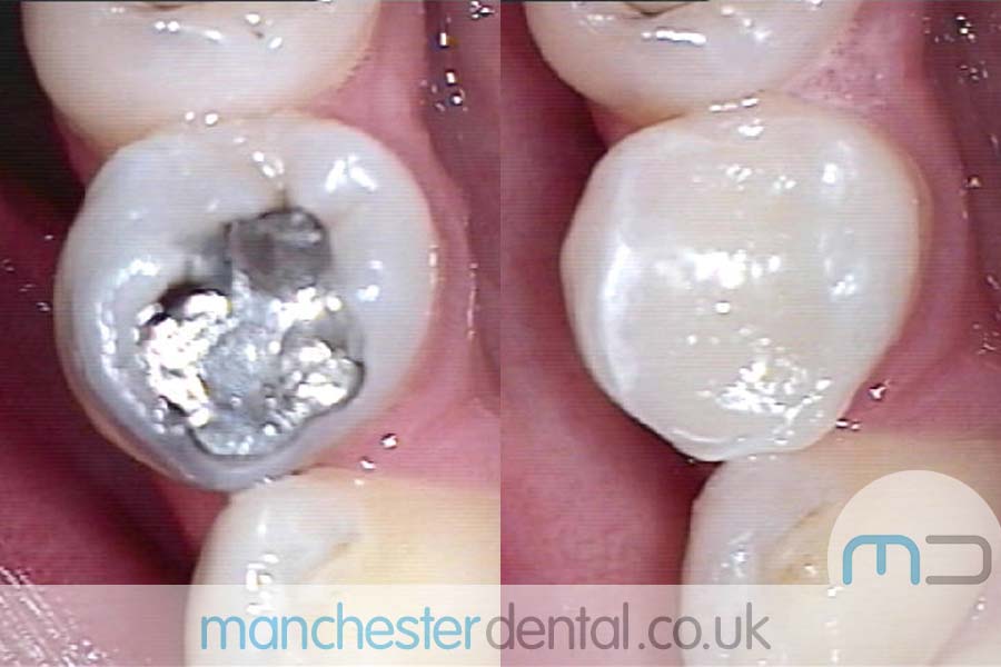 white fillings in manchester