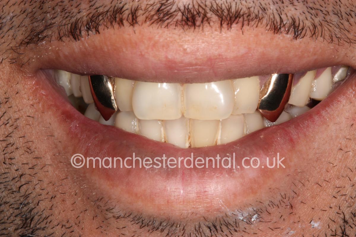 Gold Teeth / Gold Crowns - Manchester Dental